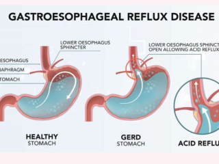 GERD Glow-Up: Exploring Cutting-Edge Reflux Solutions with GERDX / #TheGlamNtv