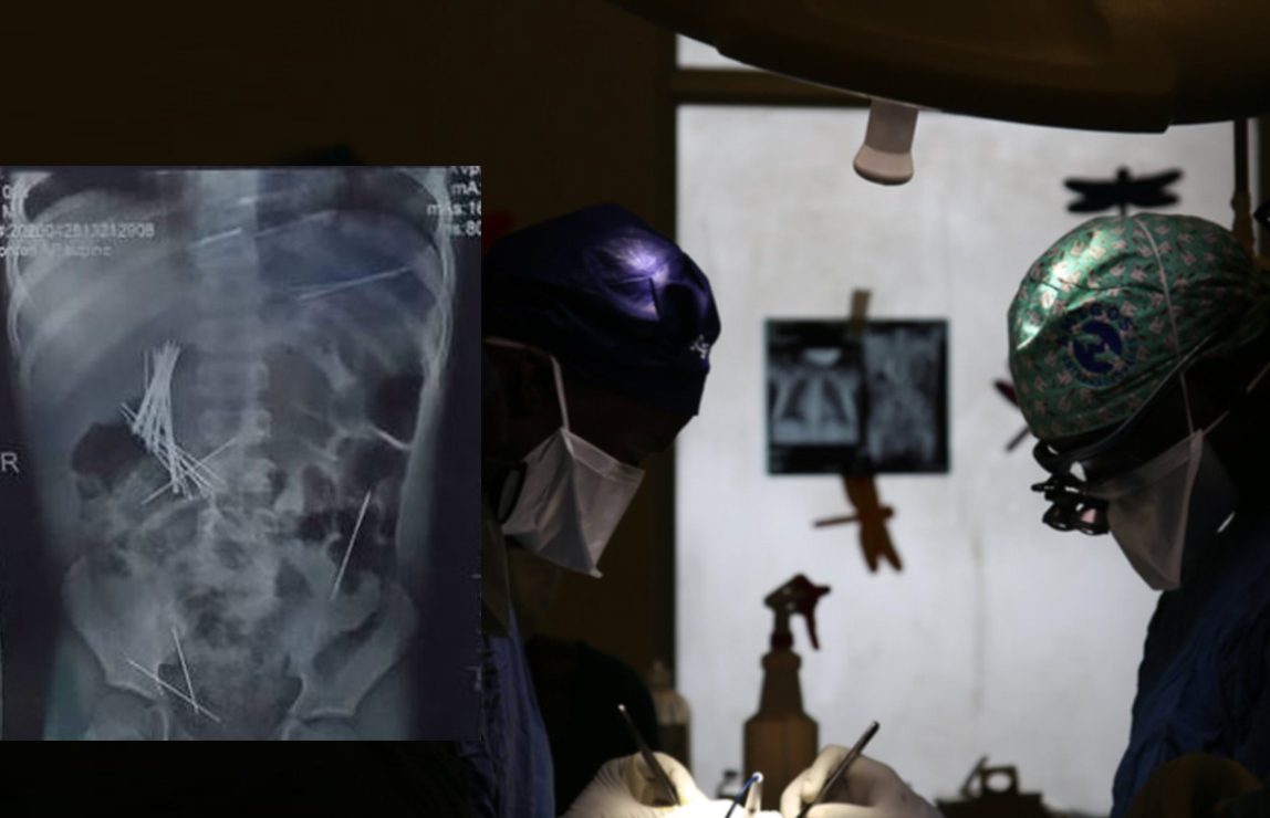 Uganda doctors remove 50 needles from boy’s stomach in alleged abuse by stepmother
