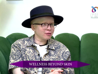 Understanding albinism skin and debunking the misconceptions | The Glam